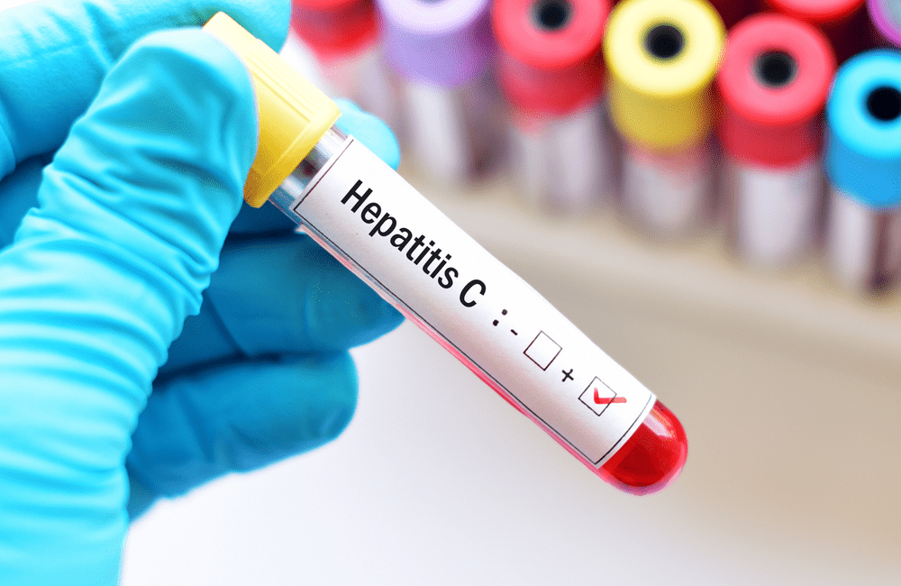 Tratamiento para la Hepatitis C: nuevas alternativas con los antivirales de acción directa